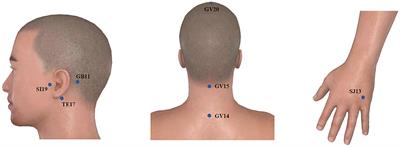 Modulations of resting-static functional connectivity on insular by electroacupuncture in subjective tinnitus